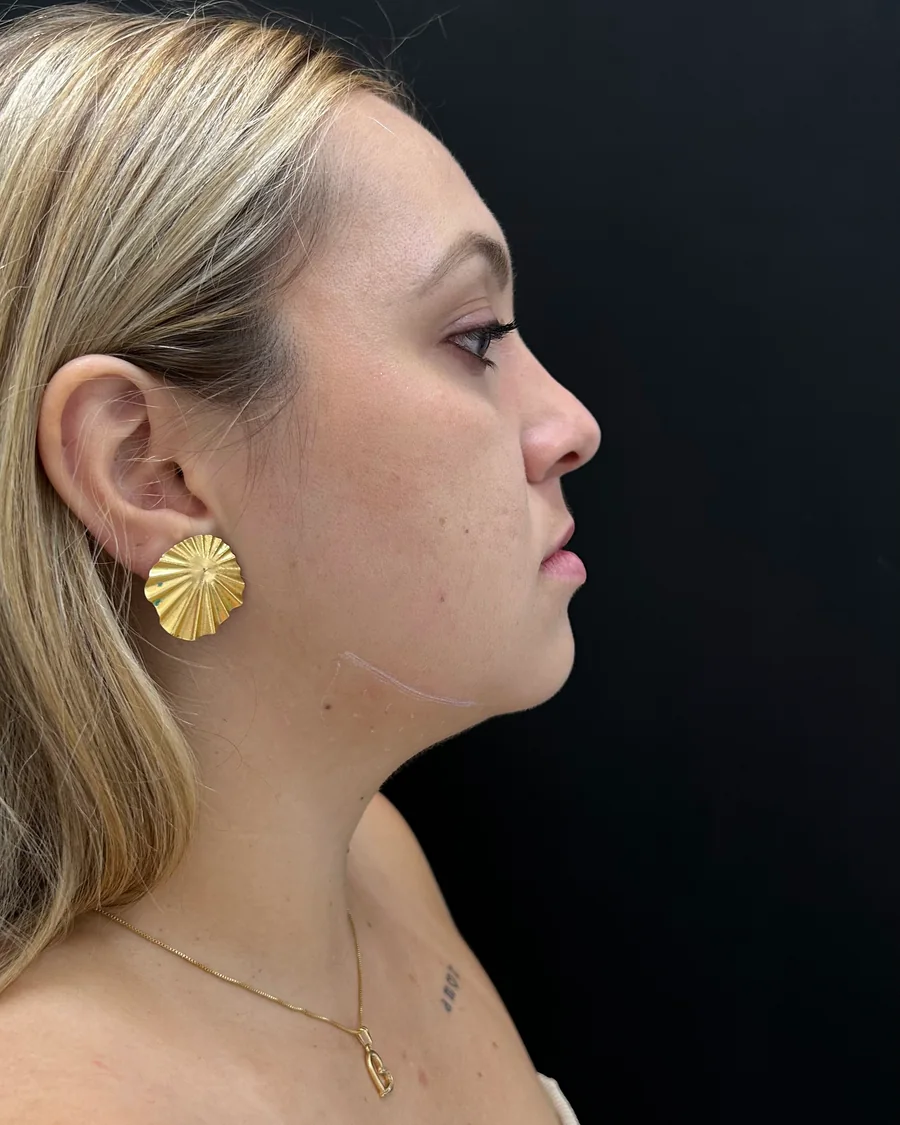 Perfil da paciente antes da correção de assimetria labial