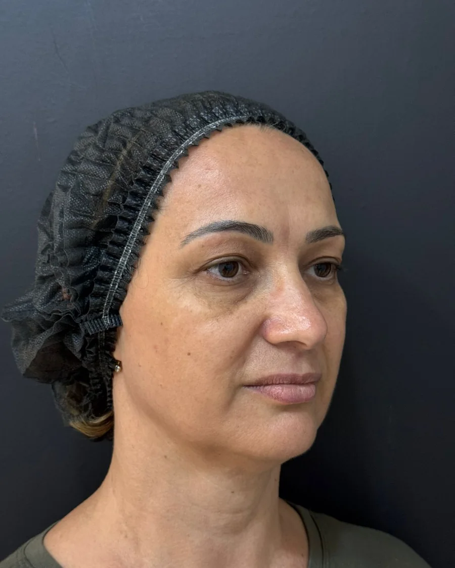 Perfil direito anterior ao planejamento Full Face