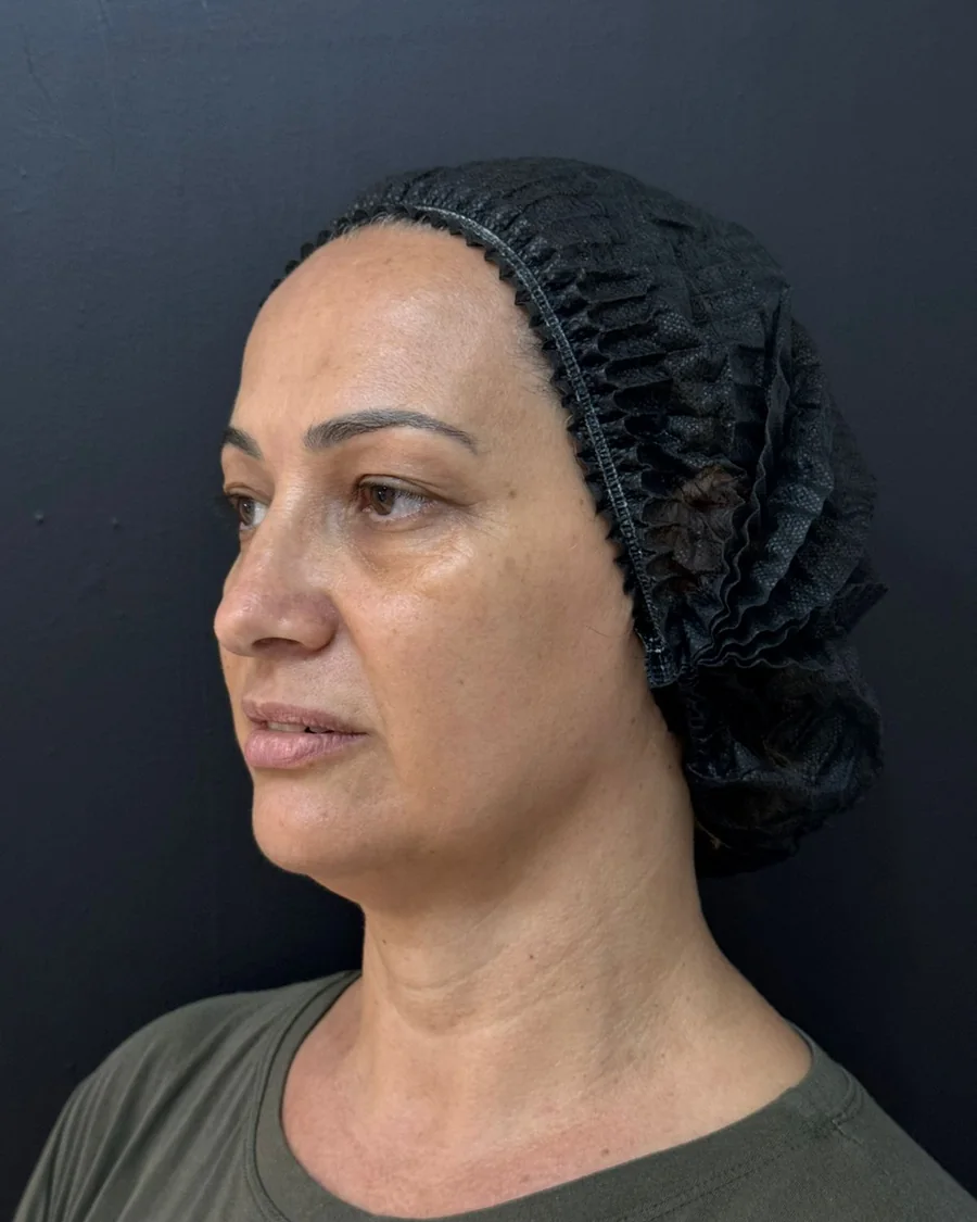 Perfil esquerdo anterior ao planejamento Full Face