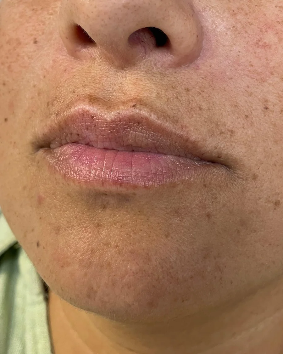 Lábios da paciente antes do preenchimento labial