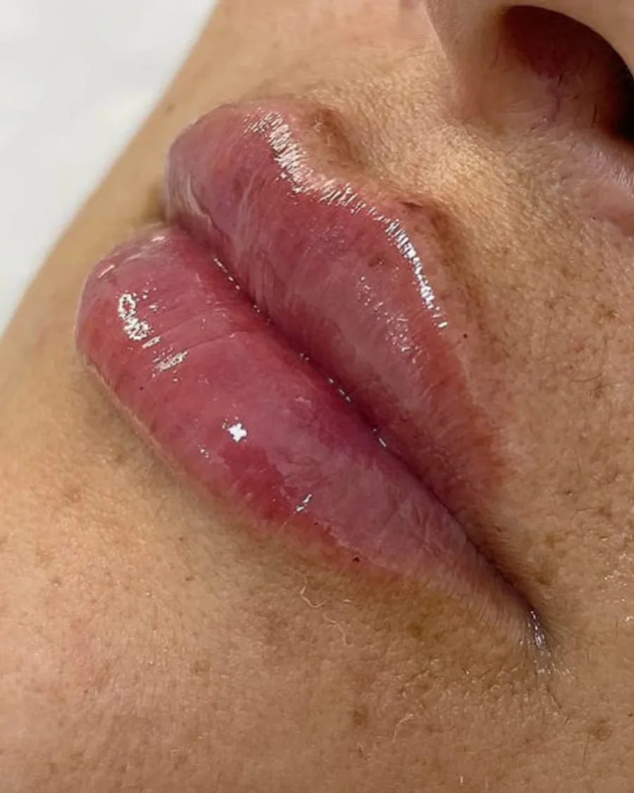 Detalhe do resultado do preenchimento labial, em maior aproximação